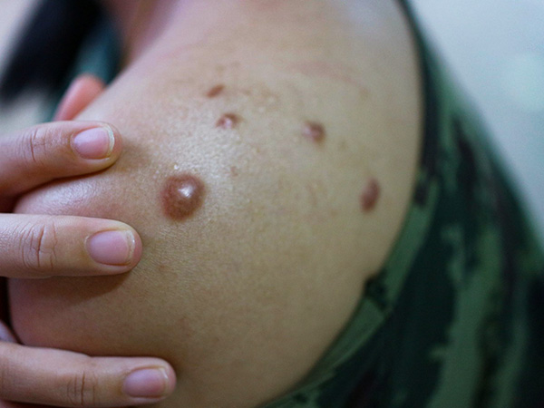 मंकीपॉक्स के लक्षण