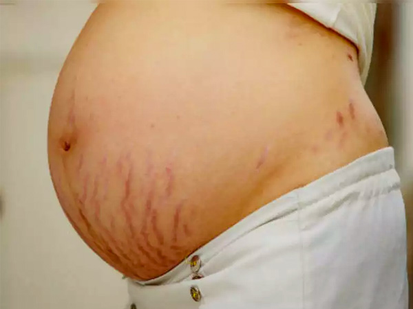 पर्पल स्ट्रेच मार्क्स क्यों होते हैं।