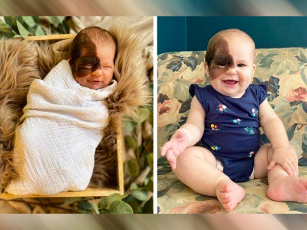 कंजेनाइटल मेलानोसाइटिक नेवस क्या है?