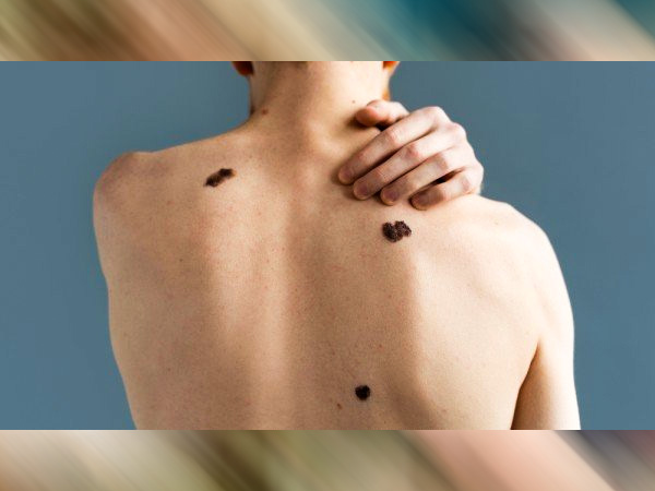 कंजेनाइटल मेलानोसाइटिक नेवस के लक्षण