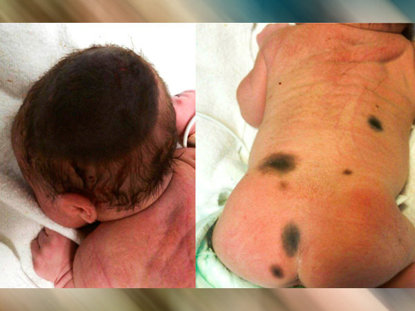 कंजेनाइटल मेलानोसाइटिक नेवस को कैसे डायग्नॉस करें