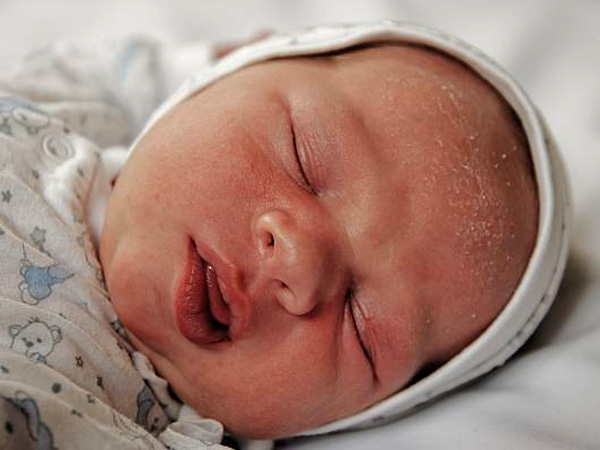 Cradle cap in babies
