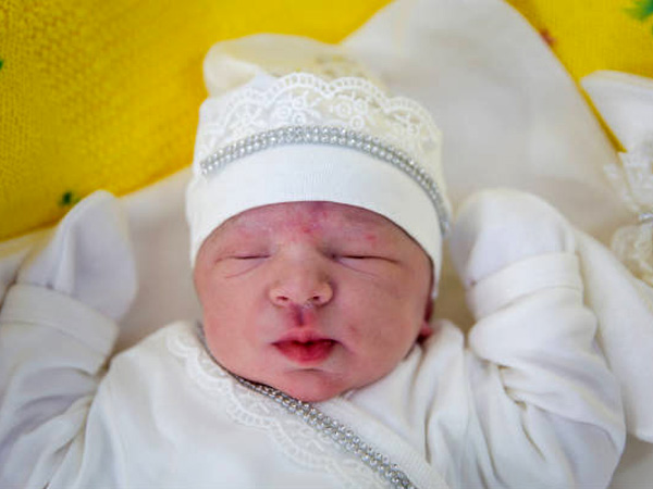 Cradle cap in babies