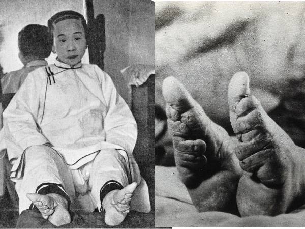 1. 10वीं शताब्दी में चीन की परंपरा - फुट बाइंडिंग