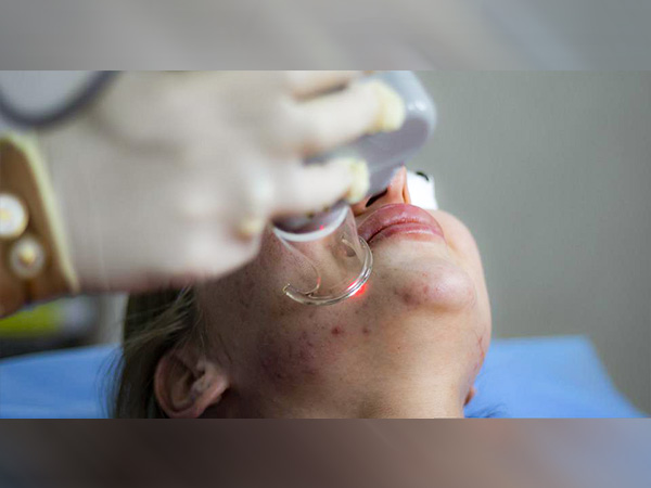 Morpheus8 Technique for Skin Tightening Know Everything About It hindi