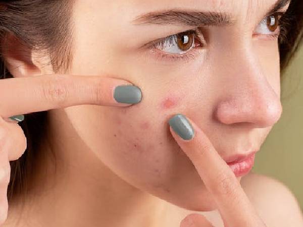 मुंहासा