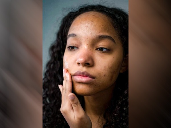 सोरायसिस के भड़कने की संभावना