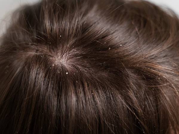 डैंड्रफ से पाए छुटकारा