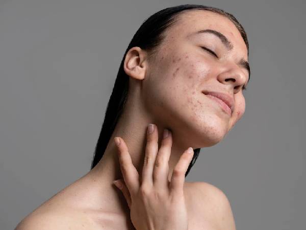 2. पिपंल की समस्या से दें छुटकारा