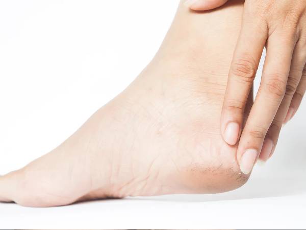 3. फटी एड़ी से पाएं राहत