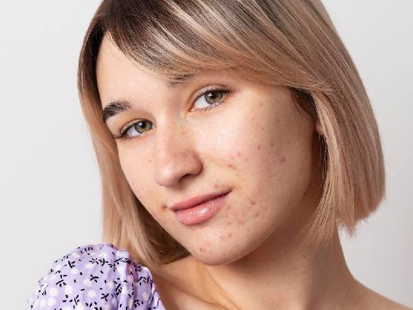 6. मुहांसे और धब्बों को करें दूर