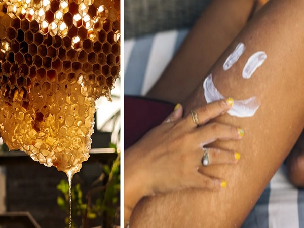 5. सनबर्न के उपचार के रूप में