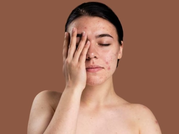 3. एक्ने स्किन के लिए चंदन का उपयोग 3. एक्ने स्किन के लिए चंदन का उपयोग