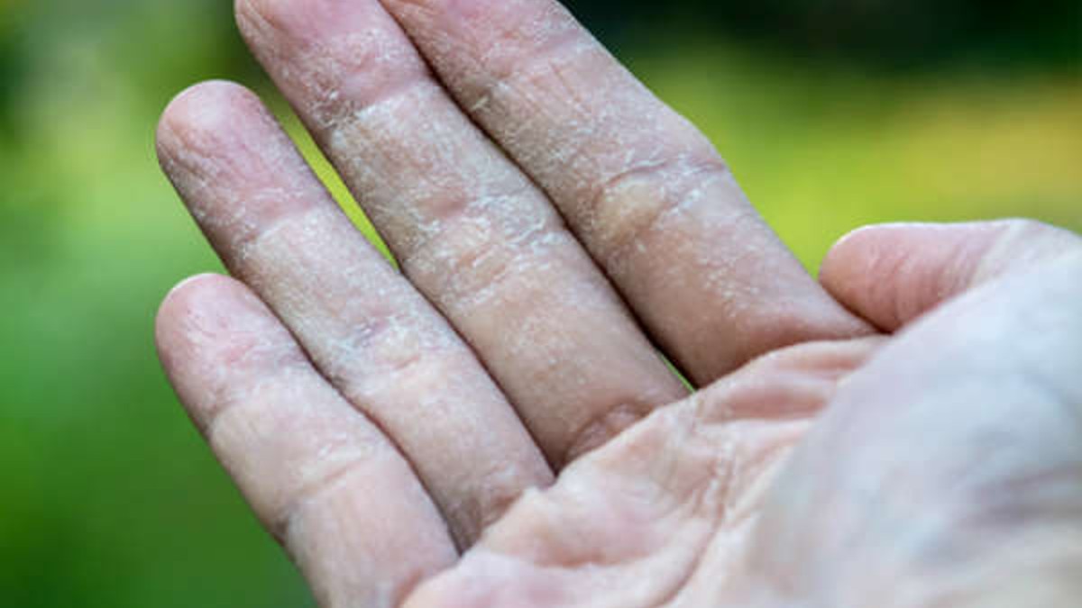 Skin Peeling Home Remedies Skin Peeling Home Remedies