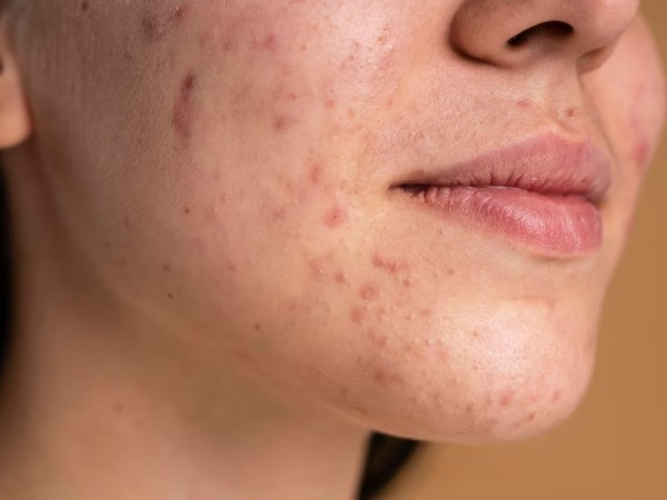 4. रेडनेस को कम करने में मददगार