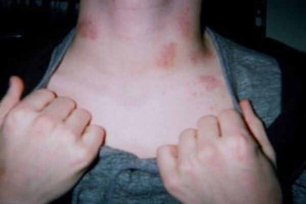 Hickey Removal Hacks Hickey Removal Hacks