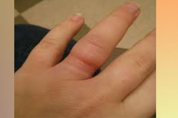 embedded ring syndrome caused by wearing tight ring Know details 