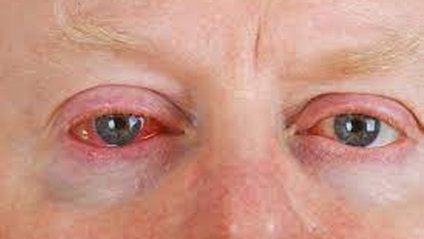 Pink Eye vs Eye Allergy