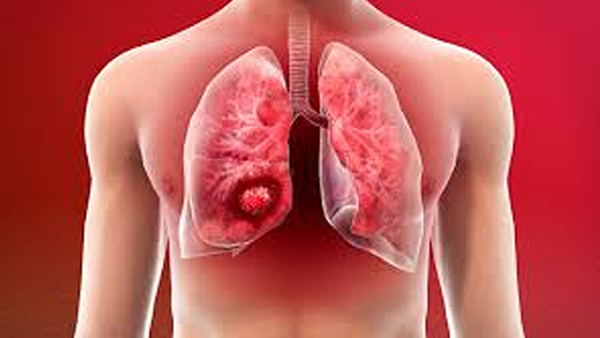 World Lung Cancer Day 2023 