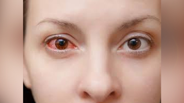 Eye Flu Hone Par Kya Kare