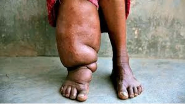 What is elephantiasis Or Lymphatic filariasis
