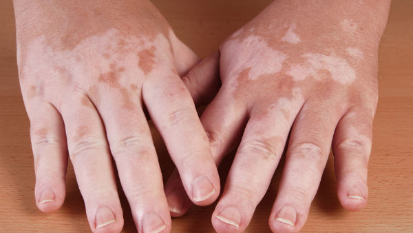  Vitiligo Or White Spot 