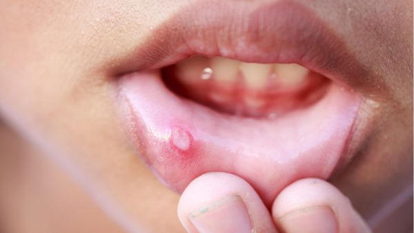 Mouth ulcers,