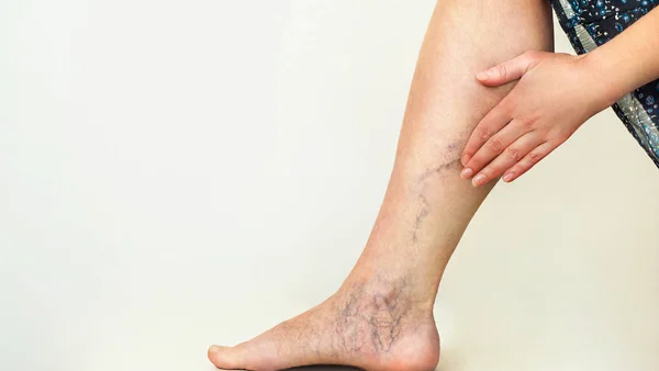 5 Myths Vs Facts About Varicose Veins