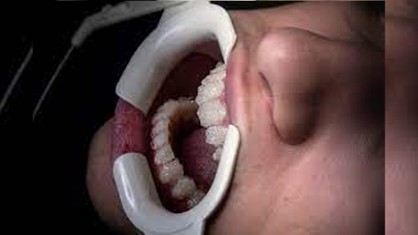 know how root canals prevent health complications in hindi