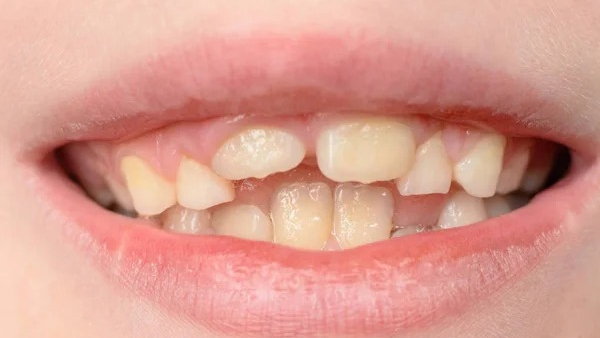 Crooked Teeth causes and treatment: