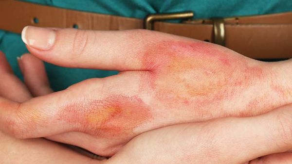 Easy Tips To Get Rid Of Ice Burn in hindi	