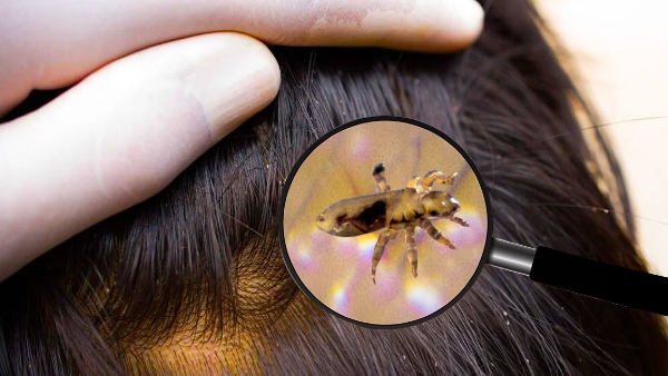 Ways To Use Tea Tree Oil For Lice Treatment in hindi	