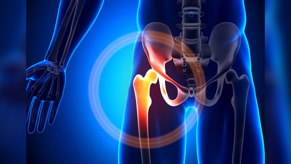 World Arthritis Day 2023: What is Osteoarthritis of the Hip Know C