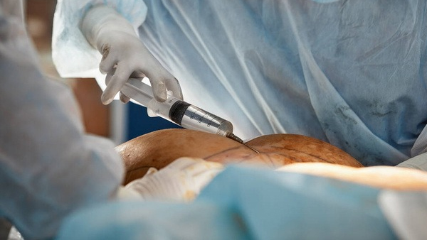 Liposuction Surgery Know Its Side Effects And Risks: