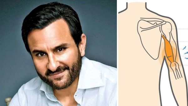 Saif Ali Khan Undergoes tricep Surgery Know its Side effects and risk factors in hindi