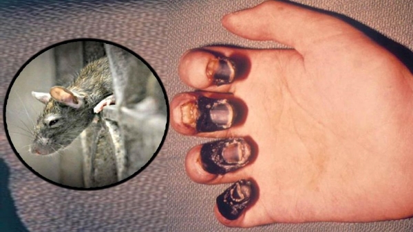  Bubonic Plague Symptoms