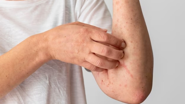 m Eczema Know Its Causes Symptoms And Treatment