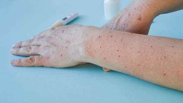 Monkey Fever Karnataka