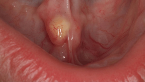 Salivary Gland Stone
