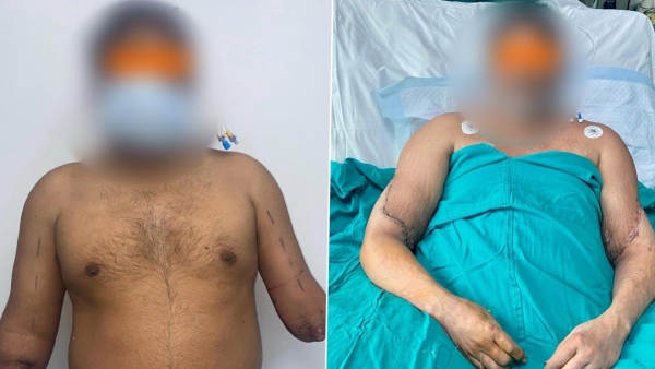 Brain-dead Woman Gives Hands To Train Accident Victim