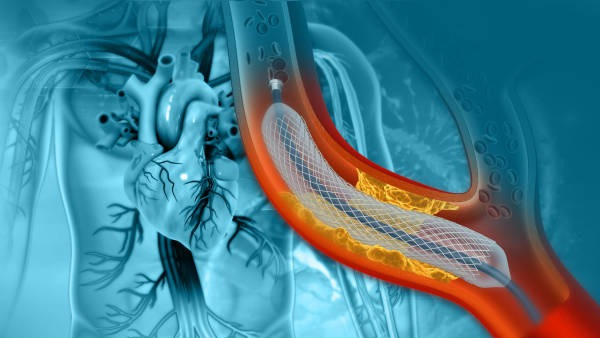 What Is Angioplasty Surgery