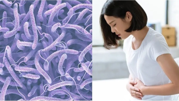 Cholera Symptoms amp amp Cause