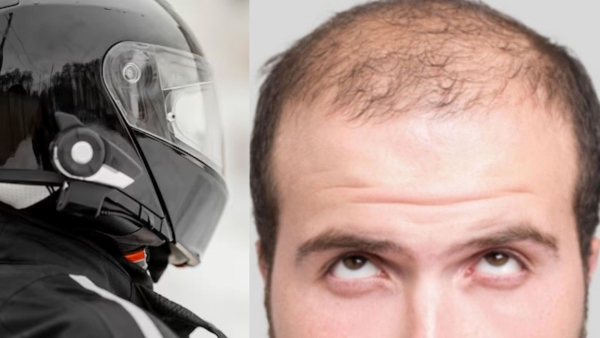 Can wearing a helmet lead to hair loss