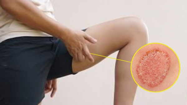 What is Jock itch Know Symptoms and causes and fastest way to cure