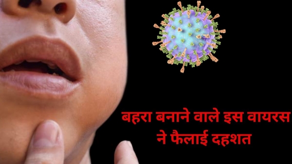 Mumps Virus In Rajasthan Mumps Virus In Rajasthan
