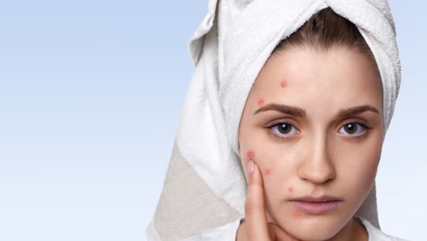 Why you should never pop pimples know side effect