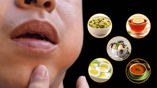 Mumps Me Kya Khana Cahiye or Kya Nhi Mumps Me Kya Khana Cahiye or Kya Nhi