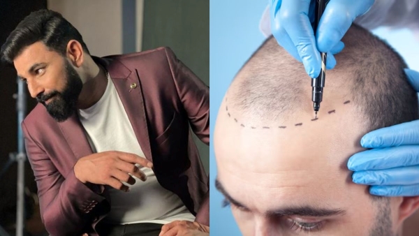 Mohammed Shami underwent DHT Hair Transplant surgery