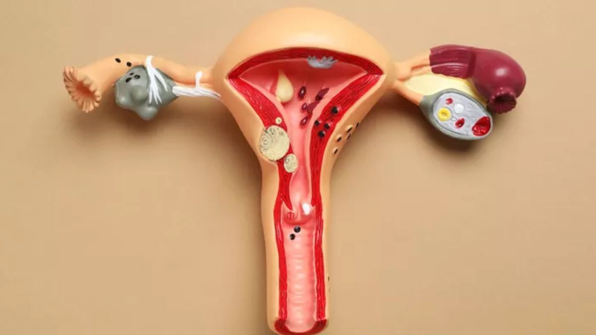 crakhi-sawant-diagnosed-tumour-in-uterus