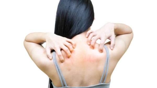 Garmi Me Ghamori Ka Ilaj home remedies for heat rash during summer season